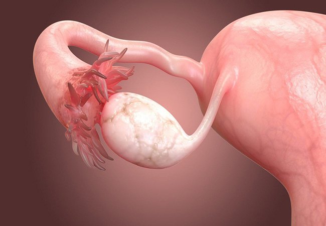Mổ u nang buồng trứng có ảnh hưởng gì không?
