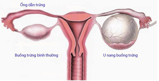 Tìm hiểu về u nang buồng trứng lành tính
