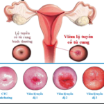 3 cấp độ của viêm lộ tuyến cổ tử cung