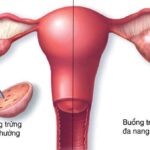Các biến chứng có thể gặp trong thai kỳ ở phụ nữ bị buồng trứng đa nang (PCOS)