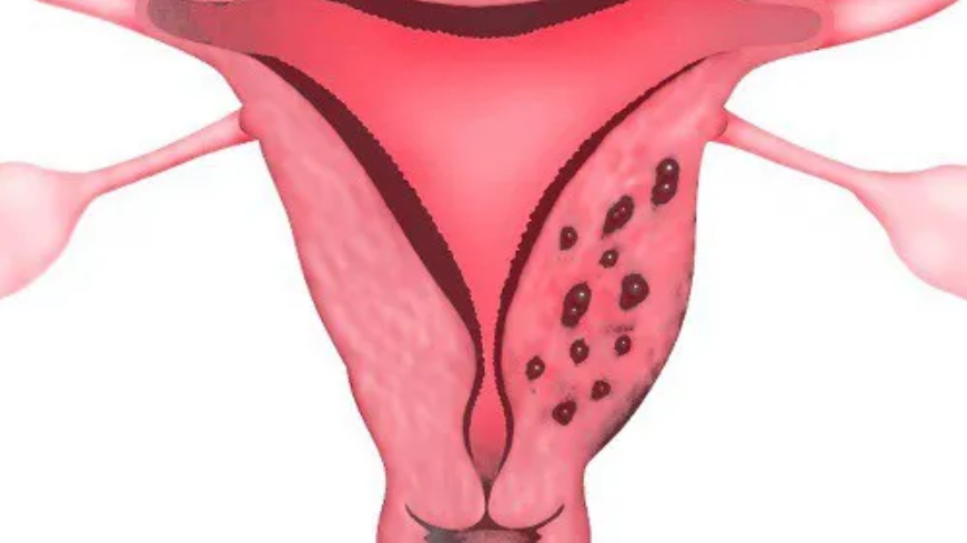 Lạc nội mạc tử cung có cần phẫu thuật?
