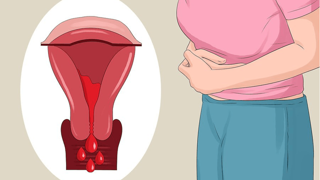 Lạc nội mạc tử cung: Các lựa chọn điều trị