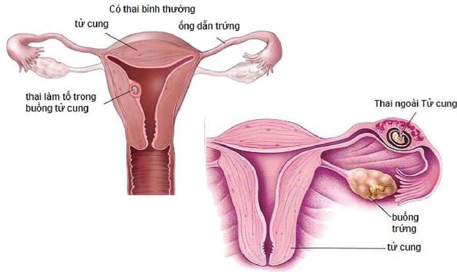 Thai ngoài tử cung: Biến chứng từ viêm ống dẫn trứng