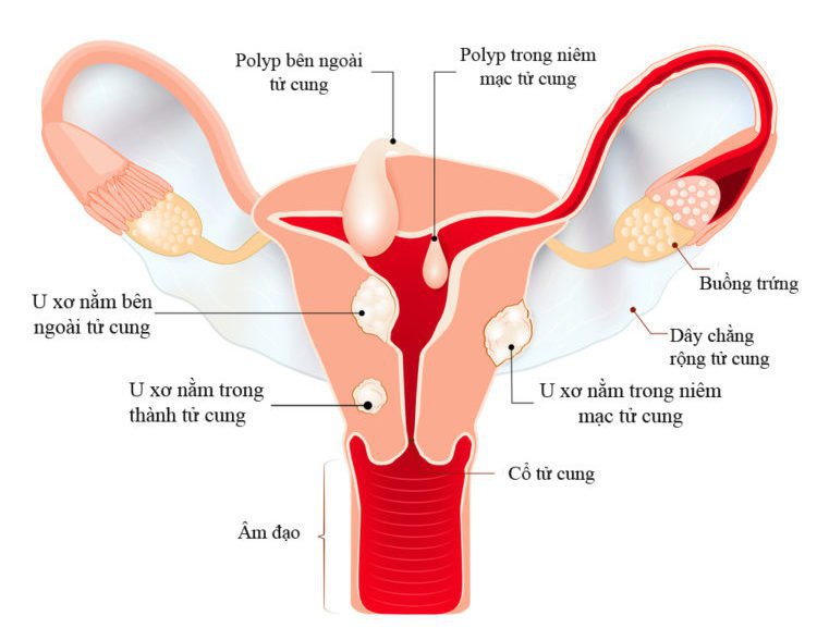Nội soi bóc nhân xơ tử cung giúp bảo tồn tử cung, phần phụ