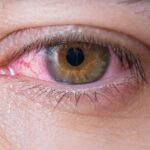 Các thuốc nhỏ mắt chữa viêm kết mạc dị ứng
