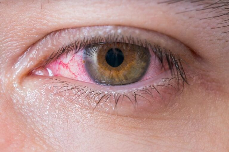Các thuốc nhỏ mắt chữa viêm kết mạc dị ứng