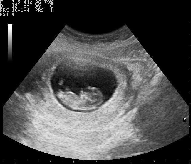 Thai 5 tuần tụ dịch dưới túi thai kèm túi thai bờ mỏng có sao không?